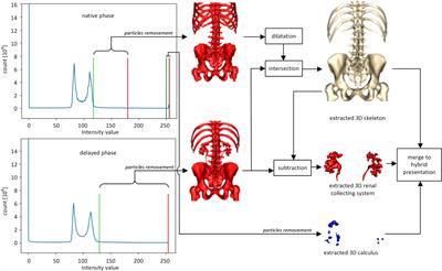 3D Imaging Segmentation and 3D Rendering Process for a Precise Puncture Strategy During PCNL – a Pilot Study